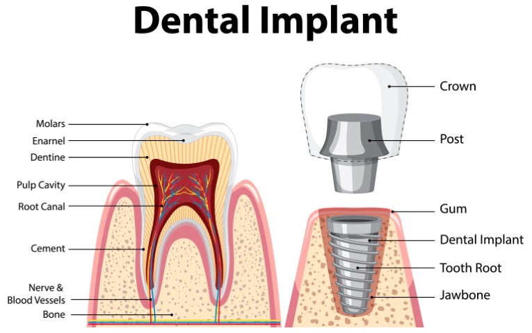 Infographic of human in structure of the dental implant illustration