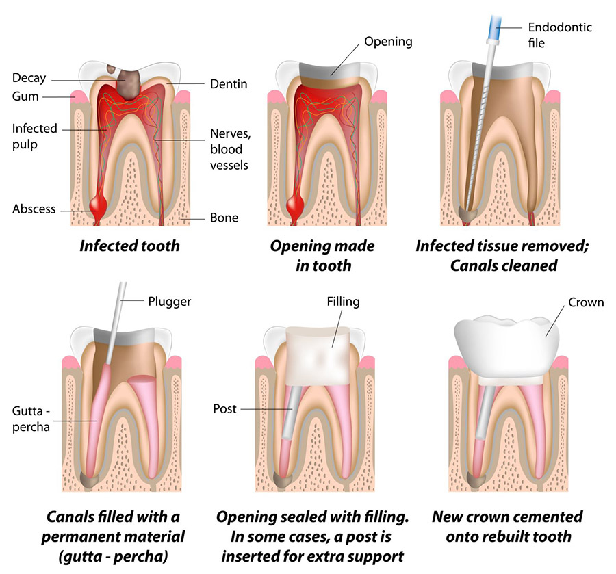 Root canal treatment diagram