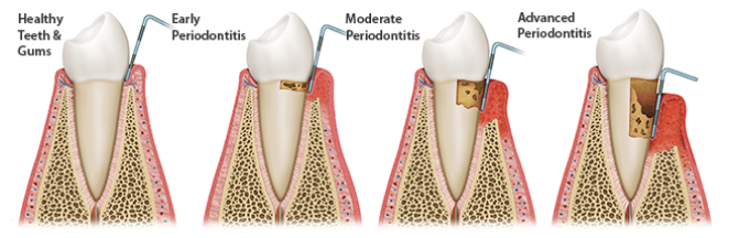 Advanced gum disease progression chart