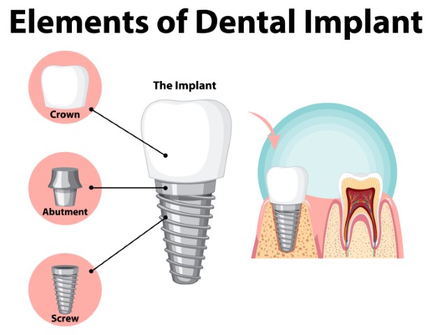 Infographic of human in structure of the dental implant