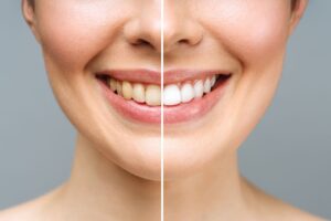 person-smiling-showing-how-to-whiten-teeth