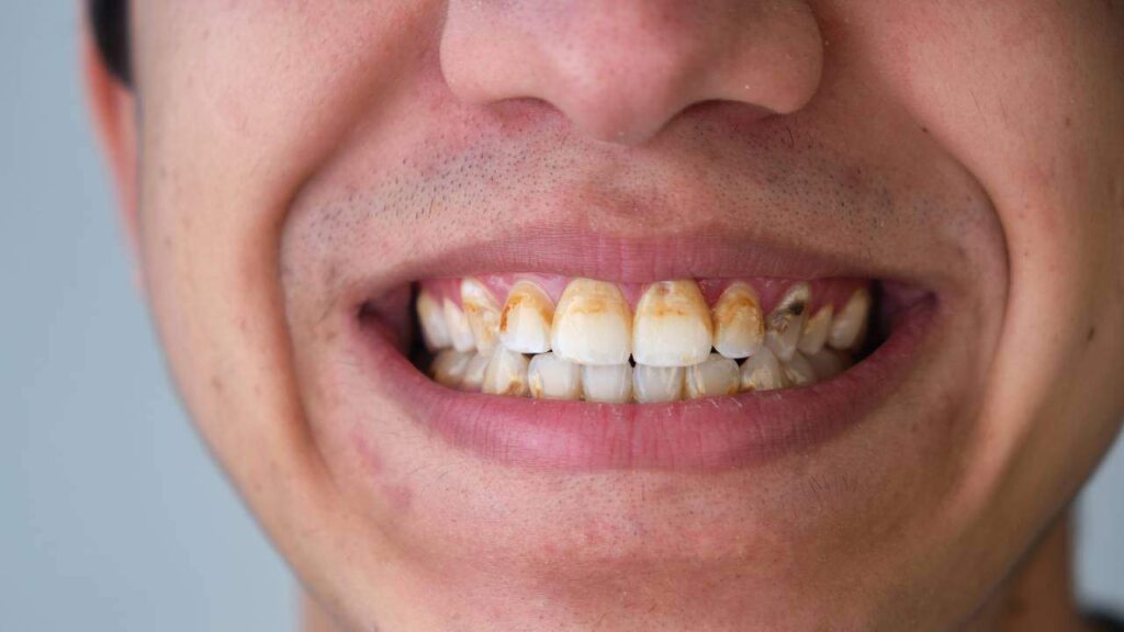 plaque-build-up-on-teeth