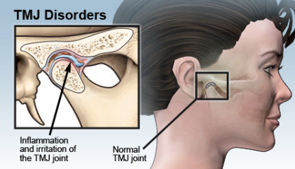 tmj disorder diagram