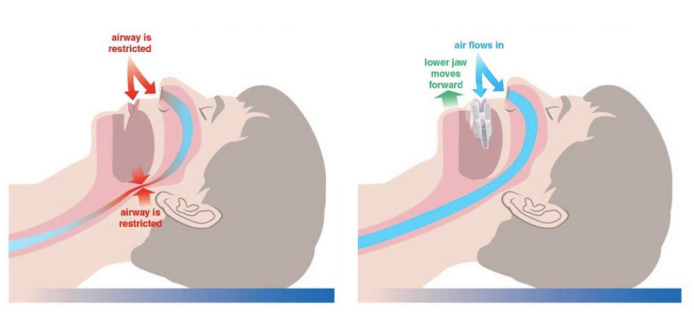 with and without MAS treatment