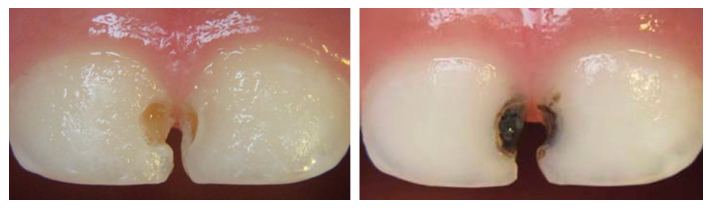 Silver Diamine Fluoride staining on teeth