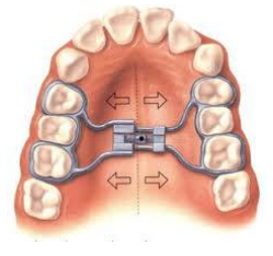 maxillary jaw expansion