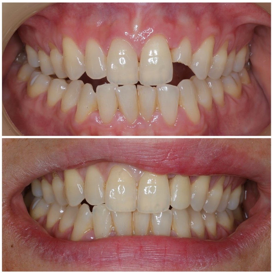 Before & After – Dental Ceramic Veneers