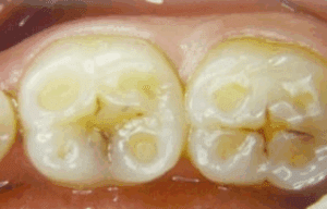 Enamel Erosion