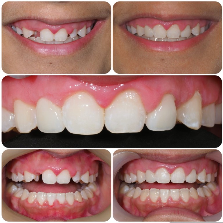 Before/After – Missing top front teeth!