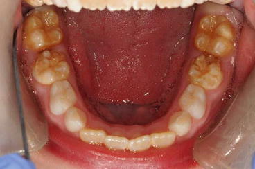 hypomineralised teeth