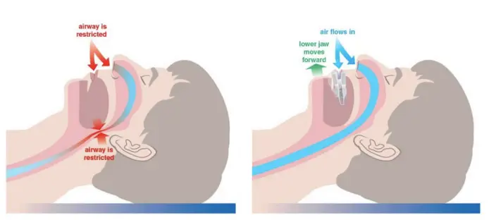 Sleep Apnoea Treatment