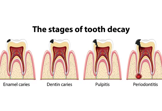 infogram stages of tooth decay