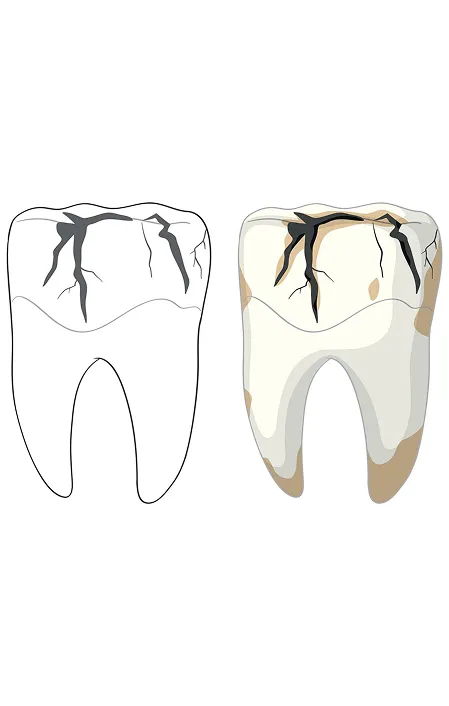 cracked tooth infogram