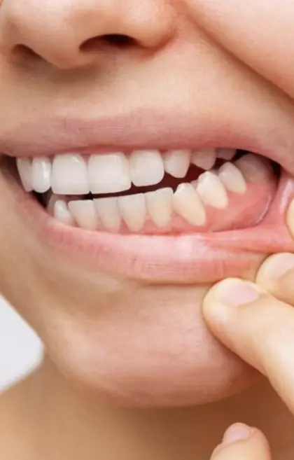 Receding Gums
