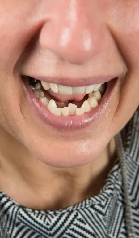 Woman With Crowded Bottom Teeth