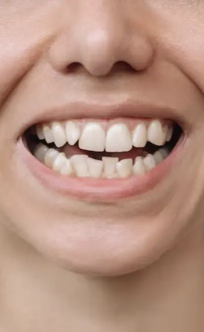 Woman With Crowded Teeth Portrait